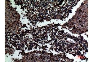 Immunohistochemistry (IHC) analysis of paraffin-embedded Human Lung Cancer, antibody was diluted at 1:100. (Galectin 3 anticorps  (C-Term))