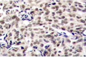 Immunohistochemistry (IHC) analyzes of CREB antibody in paraffin-embedded human breast carcinoma tissue. (CREB1 anticorps)