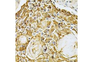 Immunohistochemistry of paraffin-embedded human esophageal cancer using ADRBK1 Antibody.