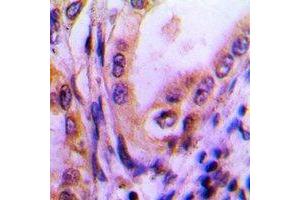 Immunohistochemical analysis of Thrombospondin 4 staining in human lung cancer formalin fixed paraffin embedded tissue section. (THBS4 anticorps)