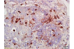 Formalin-fixed and paraffin embedded human lung carcinoma labeled with Anti-FUCA1/Alpha L fucosidase I Polyclonal Antibody, Unconjugated (ABIN682003) at 1:200 followed by conjugation to the secondary antibody and DAB staining. (FUCA1 anticorps  (AA 321-420))