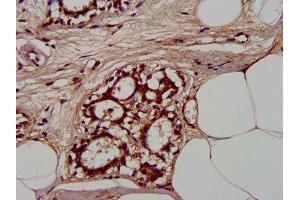 IHC image of ABIN7147581 diluted at 1:300 and staining in paraffin-embedded human breast cancer performed on a Leica BondTM system.