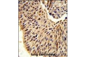 Formalin-fixed and paraffin-embedded human lung carcinoma reacted with GLIS1 Antibody (N-term), which was peroxidase-conjugated to the secondary antibody, followed by DAB staining.