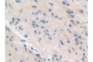 Detection of ITGb5 in Human Glioma Tissue using Polyclonal Antibody to Integrin Beta 5 (ITGb5)
