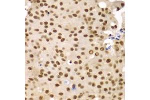 Immunohistochemistry of paraffin-embedded human oophoroma using SF3B2 antibody.