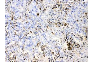 DHODH was detected in paraffin-embedded sections of human lung cancer tissues using rabbit anti- DHODH Antigen Affinity purified polyclonal antibody (Catalog # ) at 1 µg/mL. (DHODH anticorps  (N-Term))
