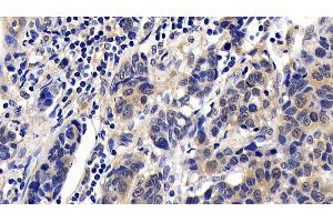 Detection of BAD in Human Lymphoma Tissue using Polyclonal Antibody to Bcl2 Associated Death Promoter (BAD)