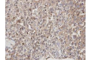 IHC-P Image Immunohistochemical analysis of paraffin-embedded human lung cancer, using DOCK 180 , antibody at 1:100 dilution. (DOCK1 anticorps  (C-Term))