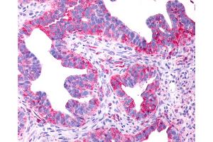 Anti-P2RY8 / P2Y8 antibody IHC of human Ovary, Carcinoma. (P2RY8 anticorps  (Cytoplasmic Domain))