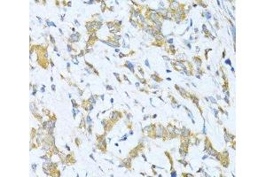 Immunohistochemistry of paraffin-embedded Human gastric cancer using KLHL42 Polyclonal Antibody at dilution of 1:100 (40x lens). (KLHDC5 anticorps)