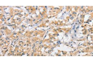 Immunohistochemistry of paraffin-embedded Human thyroid cancer using ATG10 Polyclonal Antibody at dilution of 1:60