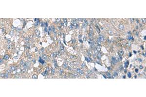 Immunohistochemistry of paraffin-embedded Human liver cancer tissue using HPCAL1 Polyclonal Antibody at dilution of 1:70(x200) (HPCAL1 anticorps)
