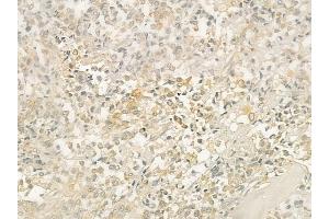 ABIN6254909 and ABIN6276368 at 1/100 staining human prostate carcinoma by IHC-P. (CD40 Ligand anticorps  (Internal Region))