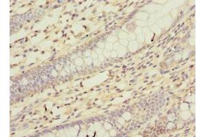 Immunohistochemistry of paraffin-embedded human colon cancer using ABIN7163978 at dilution of 1:100 (KCND2 anticorps  (AA 501-630))