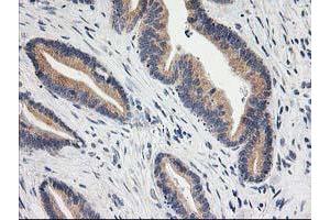 Immunohistochemical staining of paraffin-embedded Adenocarcinoma of Human colon tissue using anti-BAIAP2 mouse monoclonal antibody.