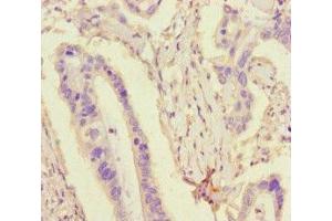 Immunohistochemistry of paraffin-embedded human pancreatic cancer using ABIN7173764 at dilution of 1:100 (TDRD3 anticorps  (AA 401-651))