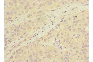 Immunohistochemistry of paraffin-embedded human liver cancer using ABIN7163378 at dilution of 1:100 (LHPP anticorps  (AA 1-270))
