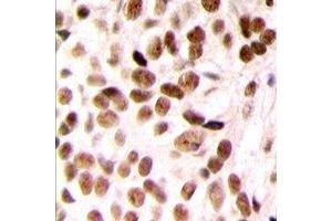 Immunohistochemical analysis of SUR2 staining in human breast cancer formalin fixed paraffin embedded tissue section. (ABCC9 anticorps  (N-Term))