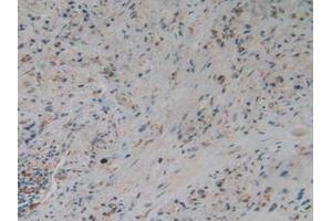 IHC-P analysis of Human Glioma Tissue, with DAB staining. (Gelsolin anticorps  (AA 577-771))