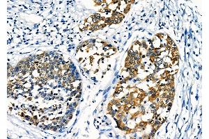 ABIN6258195 and ABIN6276040 at 1/100 staining Human esophageal cancer by IHC-P. (GPR87 anticorps  (Internal Region))