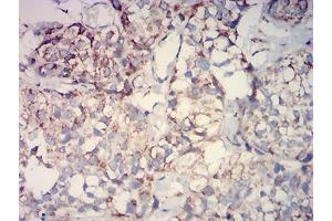Immunohistochemical analysis of paraffin-embedded bladder cancer tissues using IDH2 mouse mAb with DAB staining. (IDH2 anticorps  (AA 1-143))