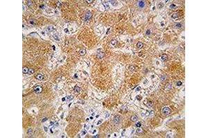 IHC analysis of FFPE human hepatocarcinoma tissue stained with APOA4 antibody (APOA4 anticorps  (AA 49-79))