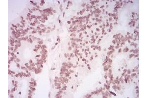 Immunohistochemical analysis of paraffin-embedded rectum cancer tissues using HIST2H4A(20Me) mouse mAb with DAB staining.