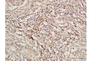 Formalin-fixed and paraffin embedded laryngeal cancer labeled with Rabbit Anti-KIF11 Polyclonal Antibody, Unconjugated  at 1:200 followed by conjugation to the secondary antibody and DAB staining (K11 (AA 351-450) anticorps)