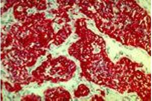 Renal cell carcinoma (MAb 2A4, cytokeratin 8, 18, 19) (Keratin 8/18/19 anticorps)