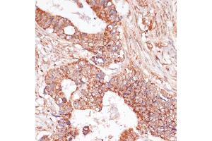 Immunohistochemistry of paraffin-embedded human colon carcinoma using MEK3 antibody (ABIN6130544, ABIN6143484, ABIN6143485 and ABIN6223650) at dilution of 1:100 (40x lens). (MAP2K3 anticorps  (AA 1-170))
