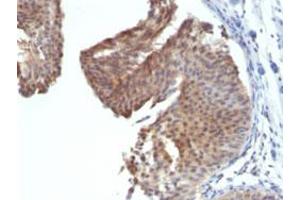 Immunohistochemical staining (Formalin-fixed paraffin-embedded sections) of human bladder carcinoma with KRT6 monoclonal antibody, clone KRT6/1702 .