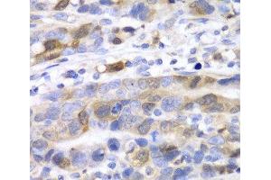 Immunohistochemistry of paraffin-embedded Human gastric cancer using UBE2C Polyclonal Antibody at dilution of 1:100 (40x lens). (UBE2C anticorps)
