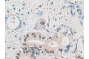 Detection of NUP50 in Human Bile duct cancer Tissue using Polyclonal Antibody to Nucleoporin 50 kDa (NUP50)