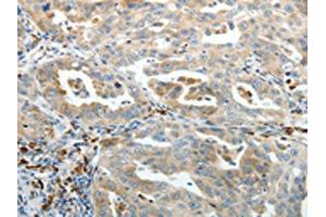 The image on the left is immunohistochemistry of paraffin-embedded Human ovarian cancer tissue using (PTEN Antibody) at dilution 1/20, on the right is treated with synthetic peptide. (PTEN anticorps)