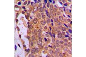 Immunohistochemical analysis of FOXO4 staining in human breast cancer formalin fixed paraffin embedded tissue section. (FOXO4 anticorps  (Center))