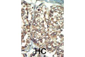 Formalin-fixed and paraffin-embedded human hepatocellular carcinoma tissue reacted with PI4K2B polyclonal antibody  , which was peroxidase-conjugated to the secondary antibody, followed by AEC staining. (PI4K2B anticorps  (C-Term))