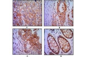Immunohistochemical analysis of paraffin-embedded human lung cancer (A), colon cancer (B), breast cancer (C) and rectal cancer(D), using EPCAM mouse mAb with DAB staining. (EpCAM anticorps)