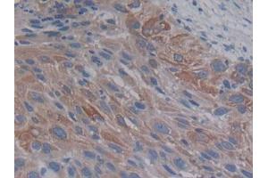 IHC-P analysis of Human Lung cancer Tissue, with DAB staining. (PCSK9 anticorps  (AA 156-461))