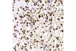 Immunohistochemistry of paraffin-embedded human kidney cancer using PHIP antibody (ABIN5974339) at dilution of 1/100 (40x lens). (PHIP anticorps)