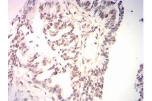 Immunohistochemical analysis of paraffin-embedded ovarian cancer tissues using BRIP1 mouse mAb with DAB staining.