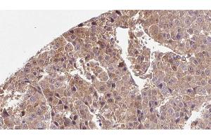 ABIN6266554 at 1/100 staining Human liver cancer tissue by IHC-P. (SLC2A3 anticorps  (C-Term))