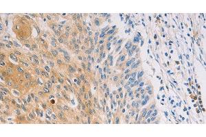 Immunohistochemistry of paraffin-embedded Human breast cancer tissue using MUC5B Polyclonal Antibody at dilution 1:30 (MUC5B anticorps)