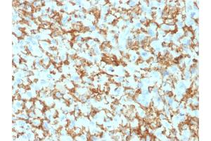 Formalin-fixed, paraffin-embedded human Histiocytoma stained with CD163 Mouse Monoclonal Antibody (M130/1210). (CD163 anticorps  (AA 43-196))