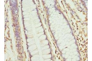 Immunohistochemistry of paraffin-embedded human colon cancer using ABIN7154797 at dilution of 1:100 (CLCN7 anticorps  (AA 626-805))