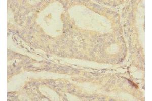 Immunohistochemistry of paraffin-embedded human endometrial cancer using ABIN7176671 at dilution of 1:100