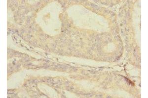 Immunohistochemistry of paraffin-embedded human endometrial cancer using ABIN7176671 at dilution of 1:100 (SLC3A1 anticorps  (AA 328-507))