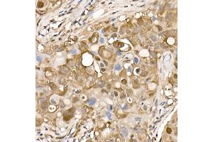 Immunohistochemistry of paraffin-embedded human breast cancer using ACLY Rabbit pAb (ABIN7265716) at dilution of 1:150 (40x lens).