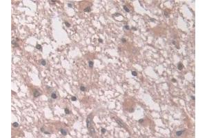 Detection of AASS in Human Glioma Tissue using Polyclonal Antibody to Aminoadipate Semialdehyde Synthase (AASS)