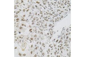 Immunohistochemistry of paraffin-embedded human lung cancer using FAF1 antibody (ABIN5975642) (40x lens). (FAF1 anticorps)