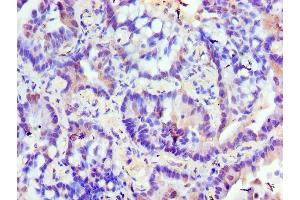 Immunohistochemistry of paraffin-embedded human lung cancer using ABIN7176599 at dilution of 1:100 (TRIM27 anticorps  (AA 214-513))